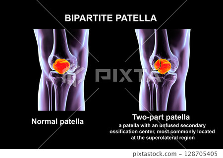 Bipartite patella, a condition where the kneecap has an unfused accessory ossification center, usually superolateral, 3D illustration. Bipartite patella, a condition where the kneecap has an unfused accessory ossification center, usually superolateral, 3D illustration. 128705405