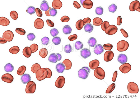 Acute lymphoblastic leukemia Acute lymphoblastic leukemia 128705474