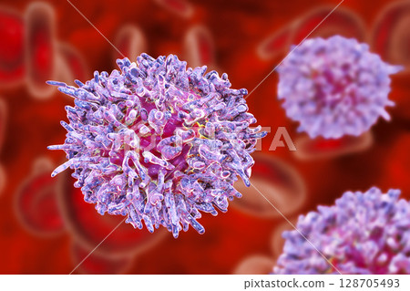 Hairy cell leukemia Hairy cell leukemia 128705493