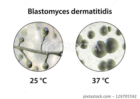 Blastomyces dermatitidis fungi 128705592