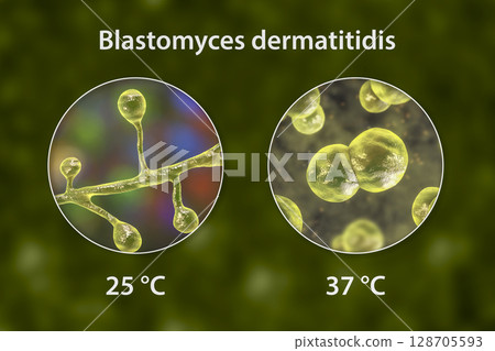 Blastomyces dermatitidis fungi Blastomyces dermatitidis fungi 128705593