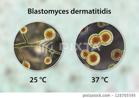 Blastomyces dermatitidis fungi 128705595