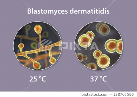 Blastomyces dermatitidis fungi Blastomyces dermatitidis fungi 128705596