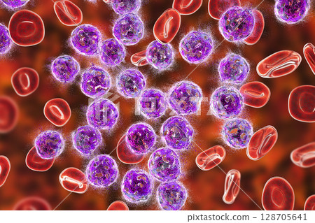 Treatment of acute lymphoblastic leukemia 128705641
