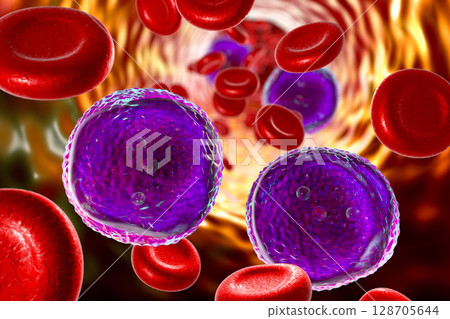 Acute lymphoblastic leukemia 128705644