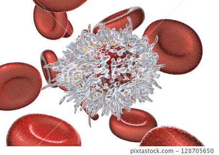 Hairy cell leukemia Hairy cell leukemia 128705650
