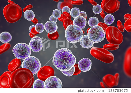 Acute lymphoblastic leukemia 128705675