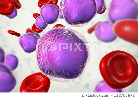 Acute lymphoblastic leukemia Acute lymphoblastic leukemia 128705678