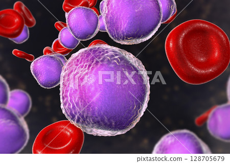 Acute lymphoblastic leukemia Acute lymphoblastic leukemia 128705679