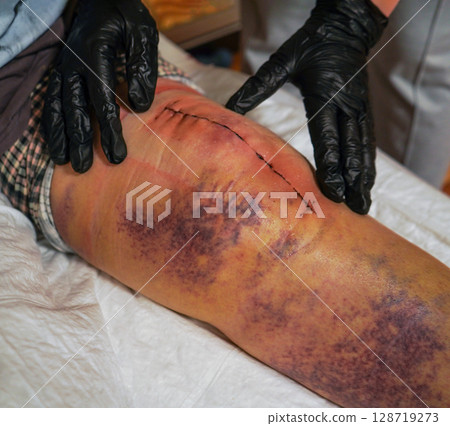 The doctor is assessing the condition of her knee, which has a scar from the procedure. 128719273