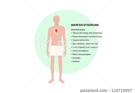 Marfan syndrome poster 128719957