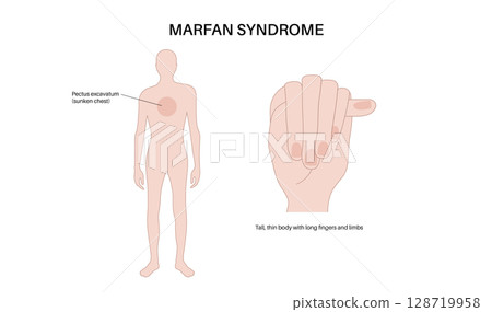 Marfan syndrome poster 128719958
