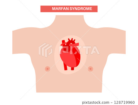 Marfan syndrome poster 128719960
