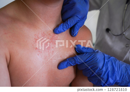 A doctor in blue gloves examines the rash on the boy's body. 128721810