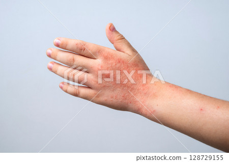 Red rashes from the Coxsackie virus on a child hand on white background. Chicken pox allergy symptoms on children's skin close-up Red rashes from the Coxsackie virus on a child hand on white background. Chicken pox allergy symptoms on children's skin close-up 128729155