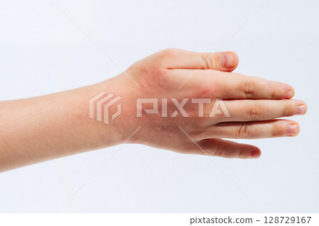 Chicken pox rash spots on child skin close-up. Coxsackie virus on the hand of baby 128729167