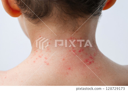 Red rashes from Coxsackie virus on a child back on a white background. Chickenpox allergy symptoms on children's skin close-up 128729173