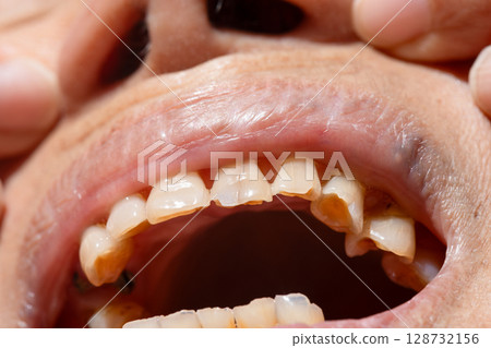 Attrition tooth due to interaction with other teeth in elderly woman. 128732156