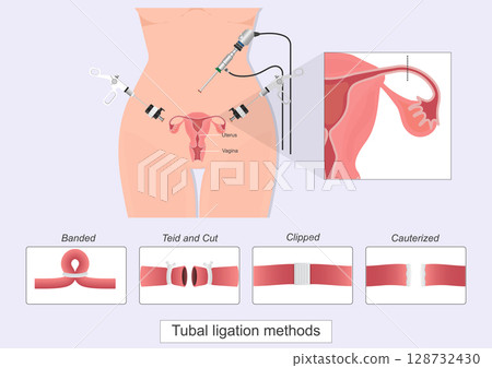 Tubal ligation is a type of permanent birth control. Tubal ligation is a type of permanent birth control. 128732430