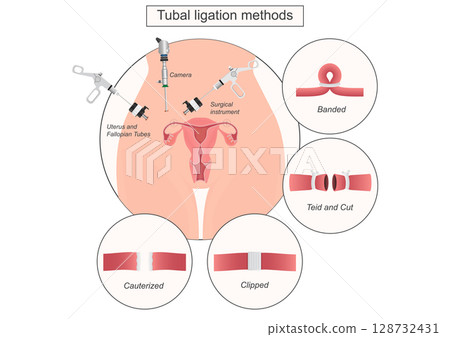 Tubal ligation is surgical procedure to prevent pregnancy. 128732431