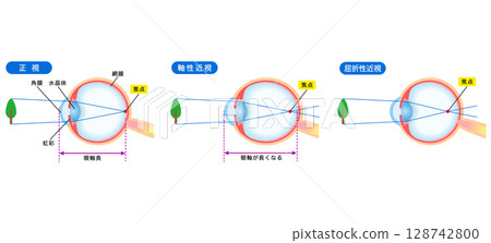 Structure of the eye, normal vision, axial myopia, refractive myopia, visual acuity Structure of the eye, normal vision, axial myopia, refractive myopia, visual acuity 128742800
