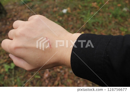 Close up scratch on hand of the back of a young woman's girl's hand. Skin injuries 128756677