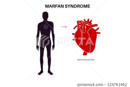 Marfan syndrome poster 128761962