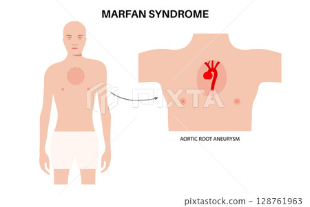 Marfan syndrome poster 128761963