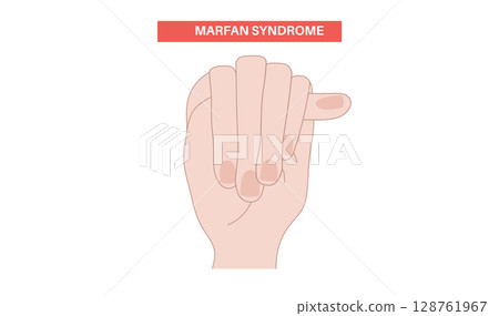 Marfan syndrome poster 128761967