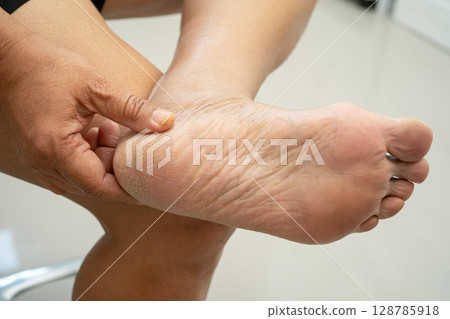 Asian woman care feet with cracked and dry heel skin cream at home. 128785918