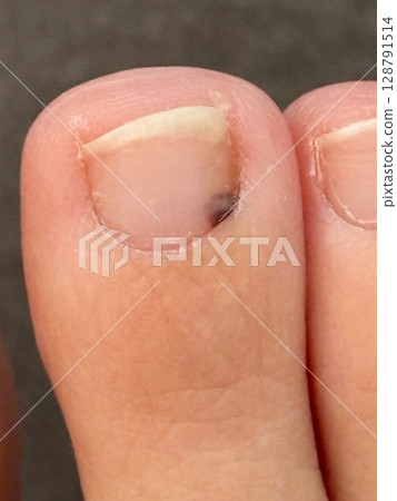 Closeup of a toe with minor blood clot under the toenail, due to ill-fitting shoes. 128791514