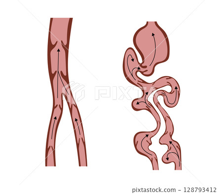 Normal Veins and Varicose Veins Showing Blood Flow Normal Veins and Varicose Veins Showing Blood Flow 128793412