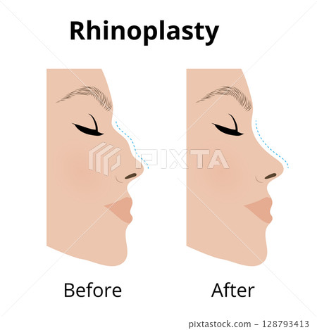 Rhinoplasty, woman showing nose before and after cosmetic surgery Rhinoplasty, woman showing nose before and after cosmetic surgery 128793413