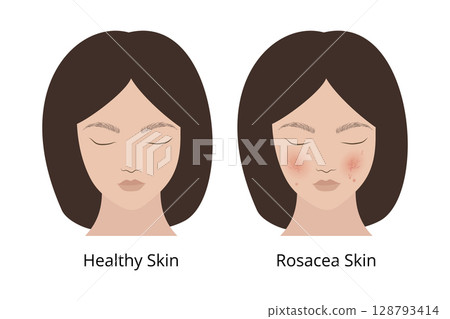 Woman showing rosacea skin and healthy skin comparison 128793414