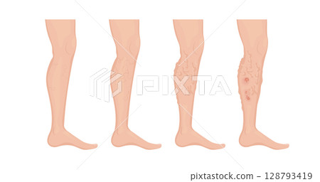 Stages of varicose veins developing on human leg Stages of varicose veins developing on human leg 128793419