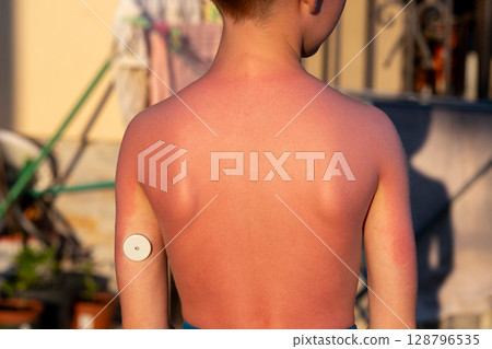 Child with sunburned back and glucose monitor standing outdoors in summer light 128796535