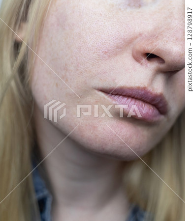 A dermatologist examines a woman's face with dilated pores, pigmentation, and sebaceous filaments. Treatment of rosacea and skin inflammation. 128798917