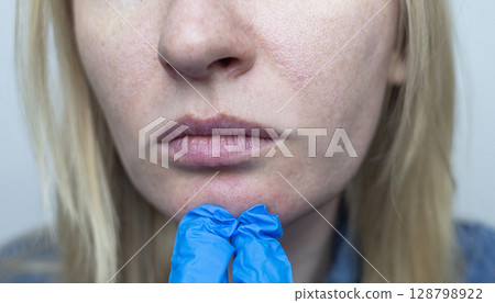 A dermatologist examines a woman's face with dilated pores, pigmentation, and sebaceous filaments. Treatment of rosacea and skin inflammation. A dermatologist examines a woman's face with dilated pores, pigmentation, and sebaceous filaments. Treatment of rosacea and skin inflammation. 128798922