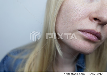 A dermatologist examines a woman's face with dilated pores, pigmentation, and sebaceous filaments. Treatment of rosacea and skin inflammation. A dermatologist examines a woman's face with dilated pores, pigmentation, and sebaceous filaments. Treatment of rosacea and skin inflammation. 128798923