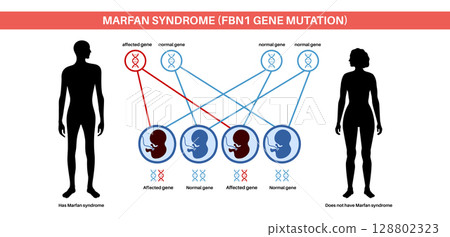 Marfan syndrome poster Marfan syndrome poster 128802323