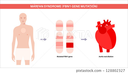 Marfan syndrome poster 128802327