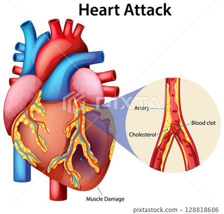 Detailed Heart Attack Medical Illustration 128818686