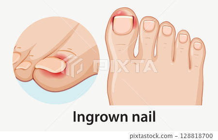 Vector Illustration of Ingrown Toenail on Human Foot Vector Illustration of Ingrown Toenail on Human Foot 128818700