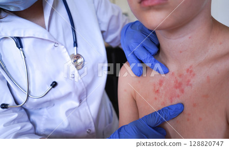 The boy's skin condition suggests an allergic reaction. The boy's skin condition suggests an allergic reaction. 128820747