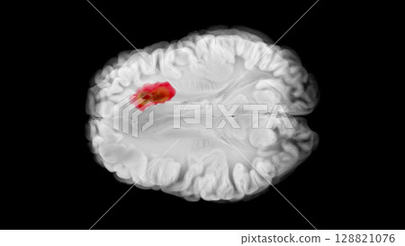 Frontal Lobe Glioblastoma in Axial Brain View 128821076