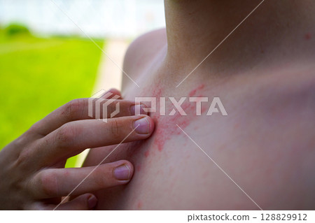 A boy scratches his hand over skin irritations caused by allergies or hives. Skin diseases, dermatology. 128829912