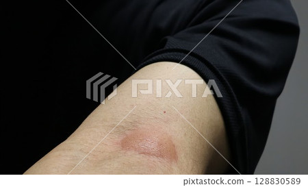 Close-up of an arm with mosquito bites Close-up of an arm with mosquito bites 128830589