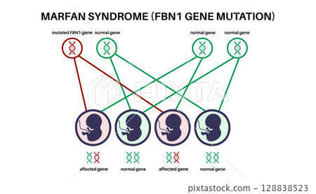 Marfan syndrome poster Marfan syndrome poster 128838523