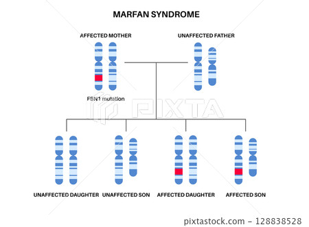 Marfan syndrome poster 128838528