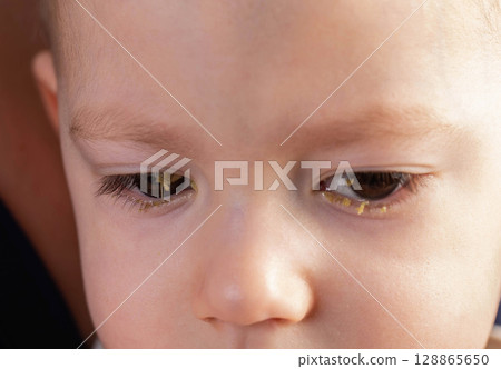 Little boy with pus in his eyes, the boy's disease is bacterial conjunctivitis. Viral infection in the eyes, close-up Little boy with pus in his eyes, the boy's disease is bacterial conjunctivitis. Viral infection in the eyes, close-up 128865650